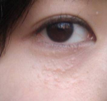 闭口什么样才是快好了,额头长闭口反反复复总是好不了