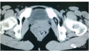 病例丨病理结果「医看2016苏州阅片大赛」病例资料11：血管肌纤维母细胞瘤#医学影像#