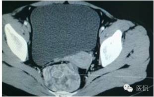 病例丨病理结果「医看2016苏州阅片大赛」病例资料11：血管肌纤维母细胞瘤#医学影像#