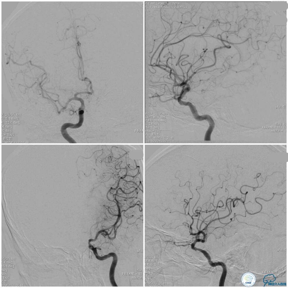 天坛周记|右椎动脉V4段慢性闭塞血管内介入治疗再通一例