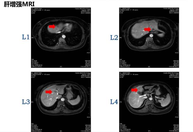 结肠癌同时性肝转移治愈案例,同时性肝转移和异时性肝转移