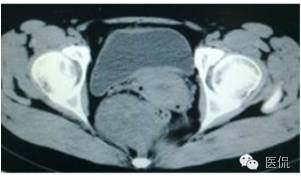病例丨病理结果「医看2016苏州阅片大赛」病例资料11：血管肌纤维母细胞瘤#医学影像#