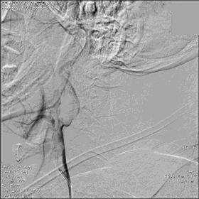 一例颈动脉栓塞的血管内介入治疗
