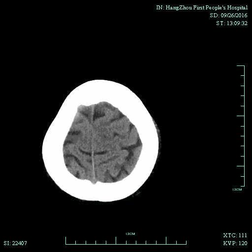 一例颈动脉栓塞的血管内介入治疗