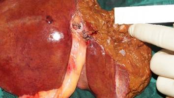 结肠癌同时性肝转移治愈案例,同时性肝转移和异时性肝转移