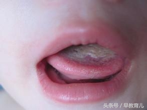 三个月的宝宝舌头发白怎么办,2周岁宝宝舌头发白怎么回事