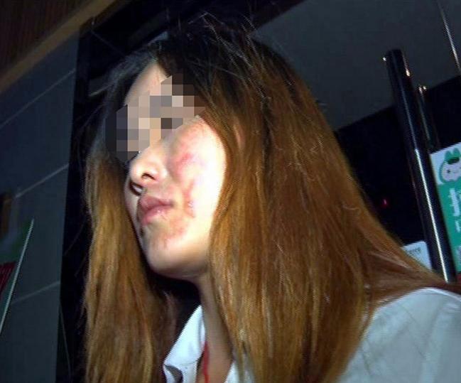 当年火锅店酒精烧伤女孩,火锅店酒精烧伤女孩