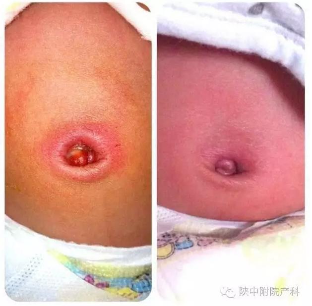 产科防跌倒温馨提示,新生儿脐带出血的原因及护理方法