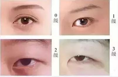 什么人适合开内眼角和外眼角,每个人都适合开外眼角吗