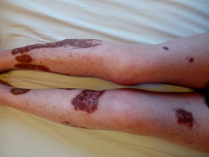 “*品毒**”引起的皮肤病变，触目惊心！