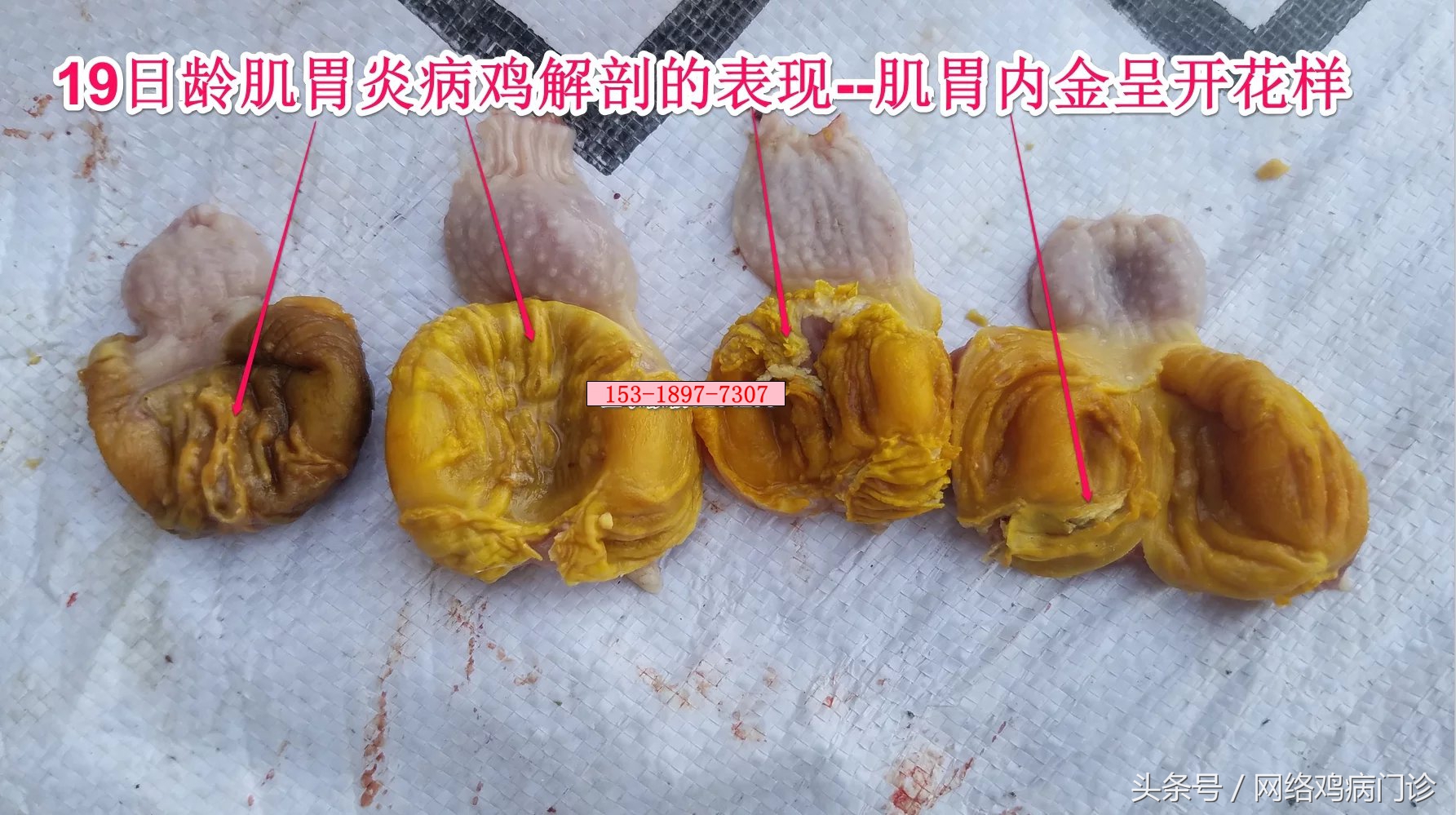 腺肌症治愈的病例分享,鸡腺肌胃炎的治疗成功案例