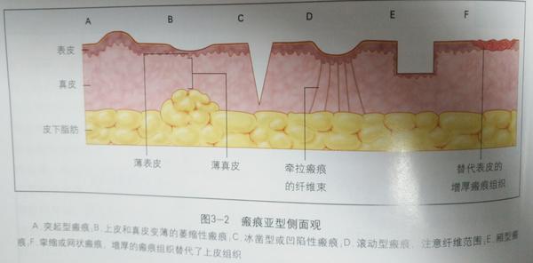 双眼皮开内眼角增生疤痕多久消失,双眼皮疤痕增生影响重睑线怎么办