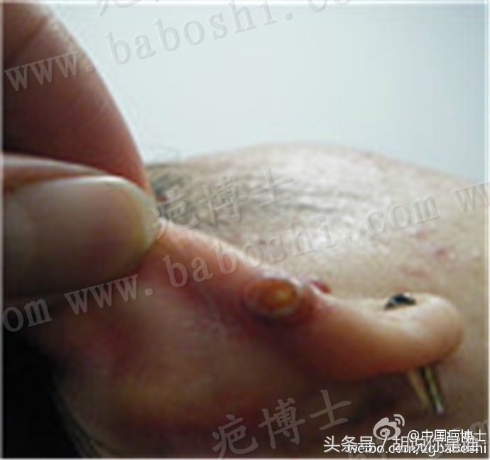 疤痕贴为什么价格悬殊这么大,疤痕一般什么价格