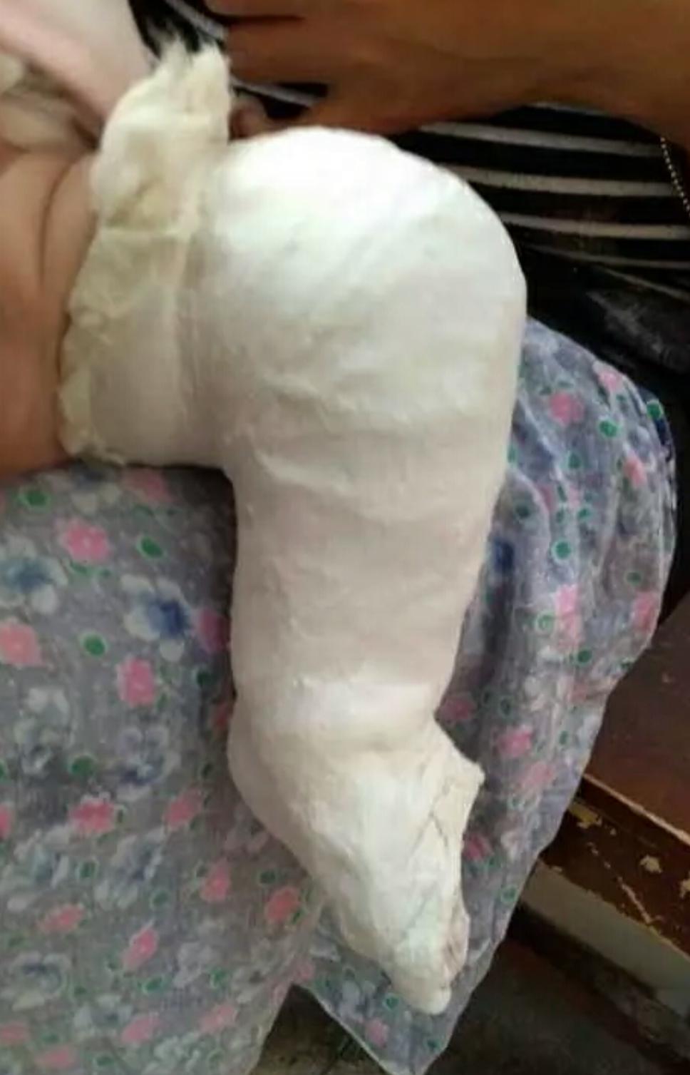 先天性马蹄足内翻可以治愈吗,马蹄足和足内翻是一样的吗