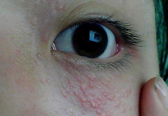 眼部脂肪粒可以消退吗,眼部脂肪粒自愈的最佳小妙招