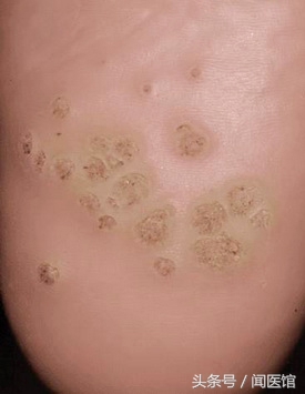 跖疣和湿疣是一种病毒吗,跖疣应与足部的鸡眼和瘊子鉴别