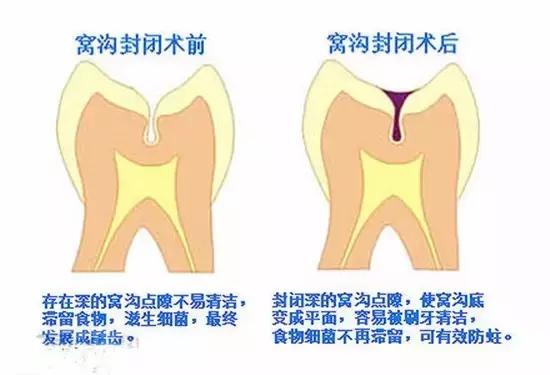 乳牙有黑点对后面换牙有危害吗,乳牙牙齿受伤变黑可以自愈吗