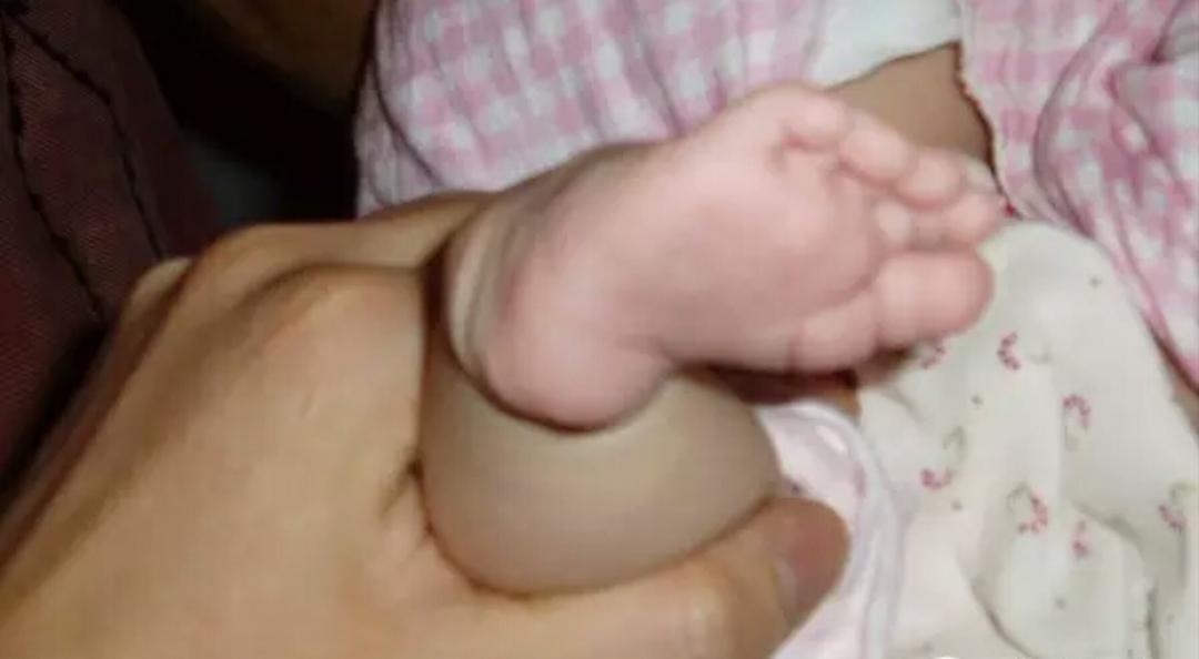 先天性马蹄足内翻可以治愈吗,马蹄足和足内翻是一样的吗