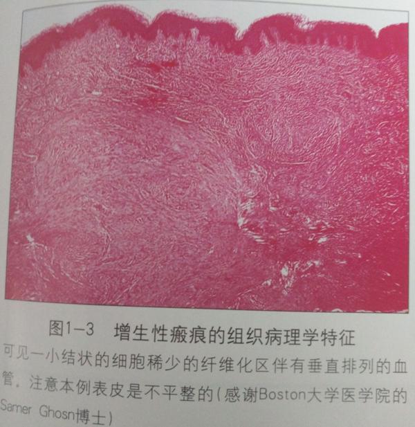 双眼皮开内眼角增生疤痕多久消失,双眼皮疤痕增生影响重睑线怎么办