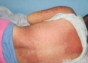 眼睛有红血丝和黄色斑块怎么消除,眼睛周围有黄色斑块怎么回事