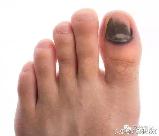 远离黑指甲,如何整治灰指甲