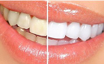 烤瓷牙怎么防止变色,烤瓷牙会变形吗