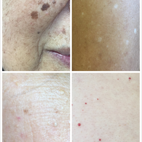 全身出现类似樱桃瘤红点,突然长了一个跟刺猴一样的疙瘩