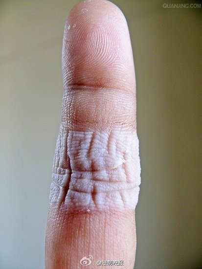 创可贴不要乱用,创可贴的正确用法快收藏吧