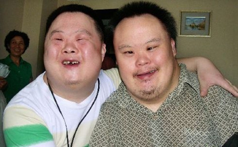 后期发现宝宝是唐氏综合征,唐氏综合征会长胖吗