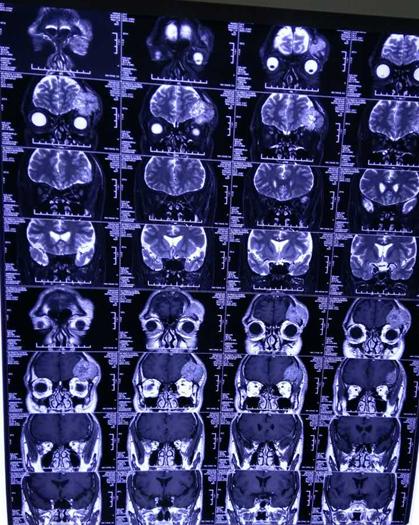 男子头上长了一大块肿瘤,男子头部长出胶状肿瘤