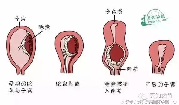 产后出血怎么办,产后出血和恶露区别