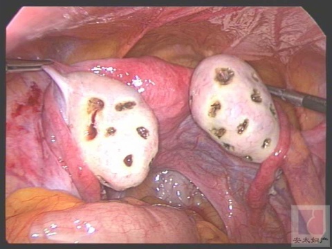 多囊顺其自然怀孕,赶走疾病迎来健康