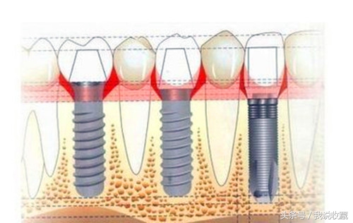 南京种植牙平民价多少一颗,种植牙的价格何时才能降下来
