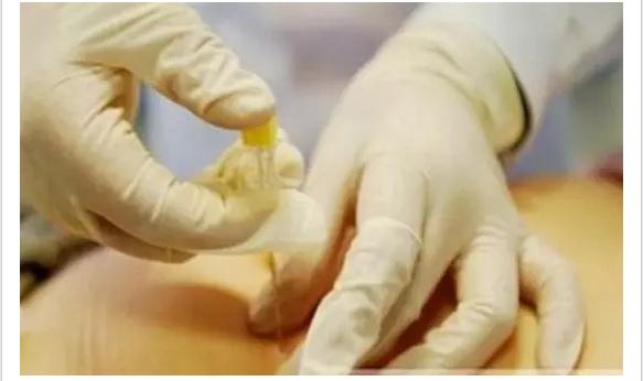 每个胖子都应该看：针灸治疗肥胖症