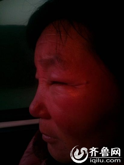 染发导致过敏皮肤溃烂,染发后皮肤过敏新闻