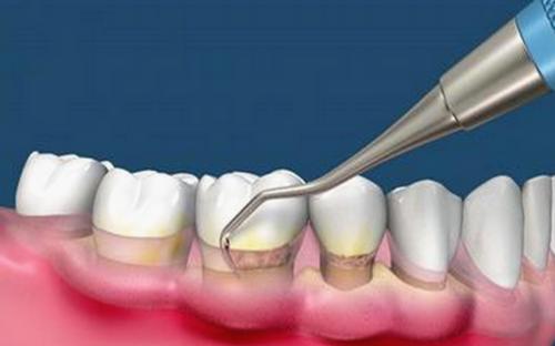 治疗牙周炎牙齿松动的偏方秘方,什么药偏方治疗牙周炎去除牙结石