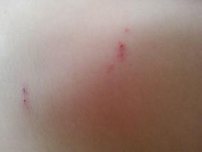 头上老出油还有毒疙瘩是怎么了,头上出油长疙瘩是怎么回事