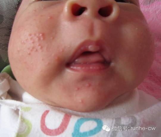 宝宝脸上总起红疙瘩是什么原因,宝宝脸上突然起红疙瘩怎么办