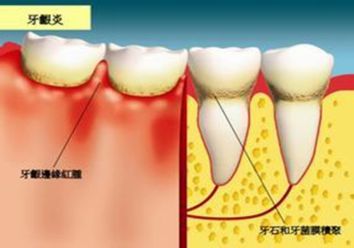 治疗牙周炎牙齿松动的偏方秘方,什么药偏方治疗牙周炎去除牙结石