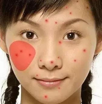 突然长很多痘是有什么病吗,3种长痘的原因了解一下你中了吗