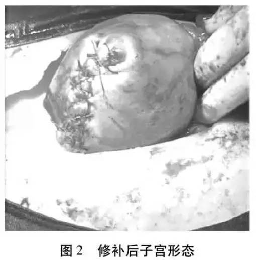 高危妊娠宫外孕切除输卵管,输卵管妊娠破裂手术记录单模板