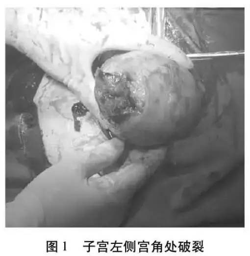 高危妊娠宫外孕切除输卵管,输卵管妊娠破裂手术记录单模板