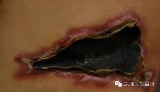 洗纹身感染出脓溃烂会不会留疤,洗纹身伤口发炎溃烂多久不疼