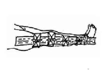 滑雪受伤骨折怎么理赔,滑雪骨折怎么恢复