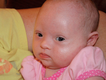 后期发现宝宝是唐氏综合征,唐氏综合征会长胖吗