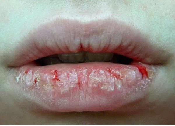 冬天嘴皮干裂怎么办,南方人冬天到北方嘴唇干裂怎么办