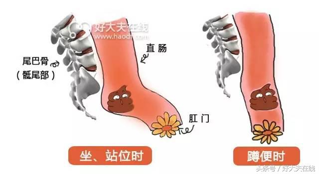 脚不方便上厕所怎样蹲坑,如何上厕所蹲坑不脚麻