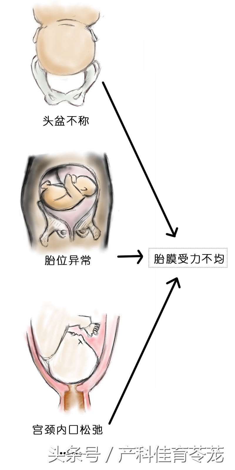 破水了，害怕吗？产科医生教您这样应对