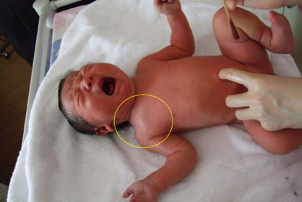 胎儿头大顺产卡住助产,胎儿头被骨盆卡住怎么办