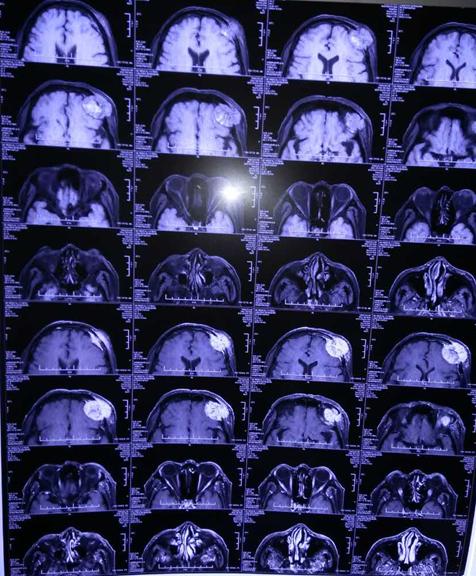 男子头上长了一大块肿瘤,男子头部长出胶状肿瘤